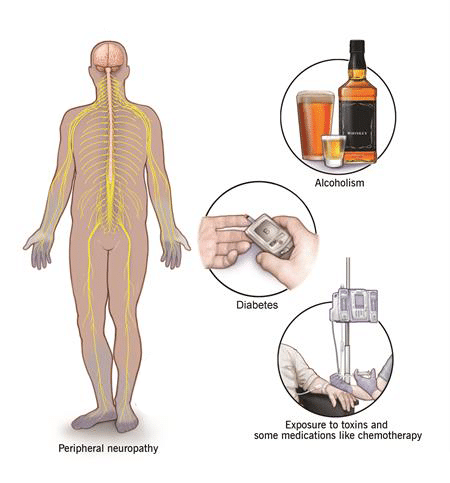 Causes of Neuropathy include diabetes