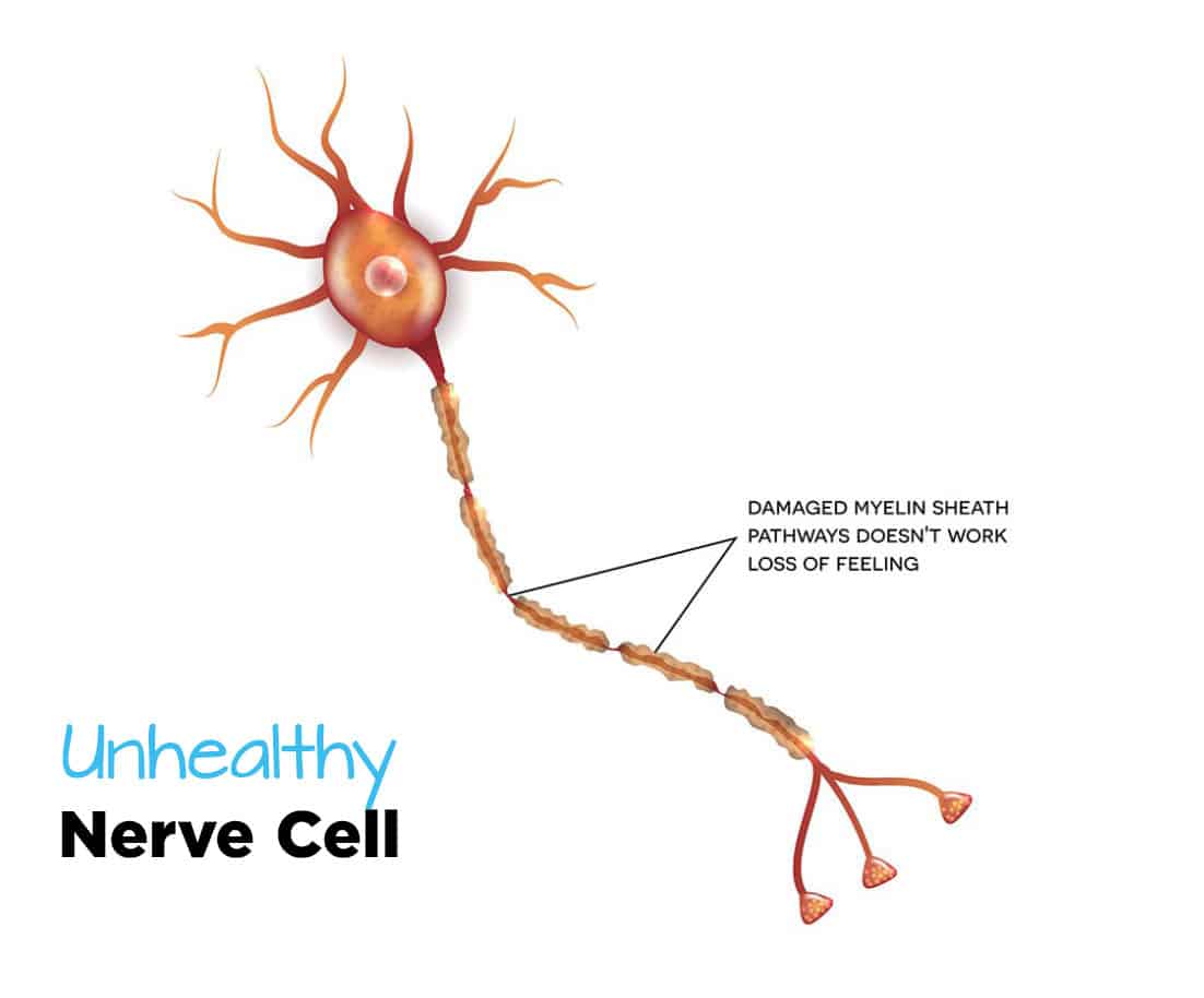 unhealth Nerve Cell Infographic