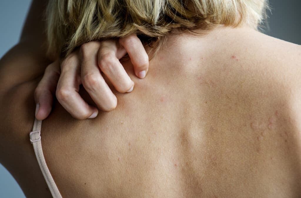 postherpetic neuralgia affecting a woman's back.